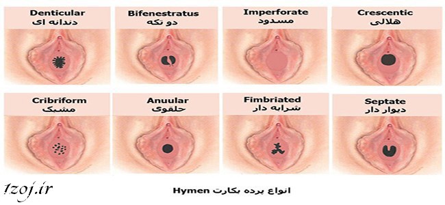 types-of-hymen