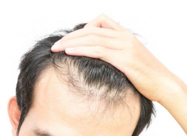 علت زود چرب شدن موی سر چیست