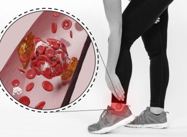 علائم غلظت خون در پاها چیست ؟